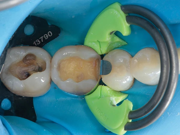 DualForce™ Molar Rings