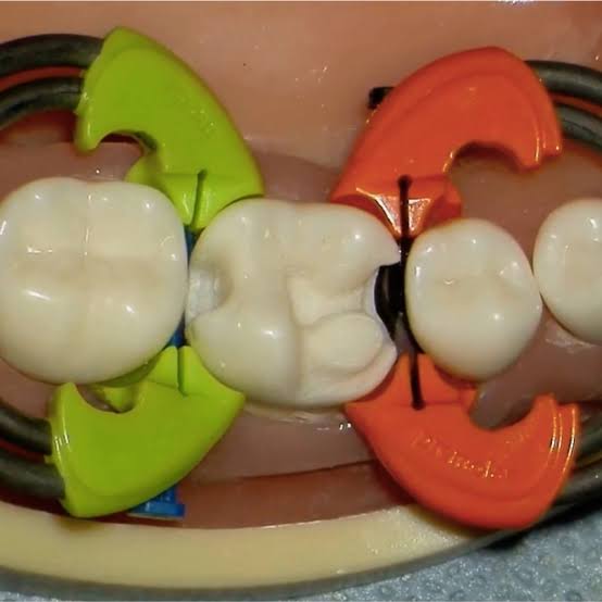 DualForce™ Molar & Pre-Molar Rings